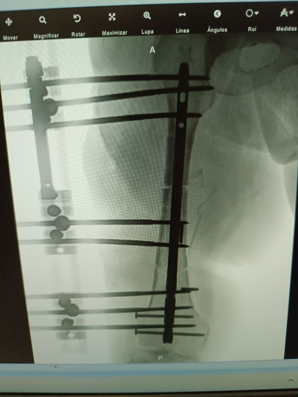 Radiografía con fijación externa Ilizarov