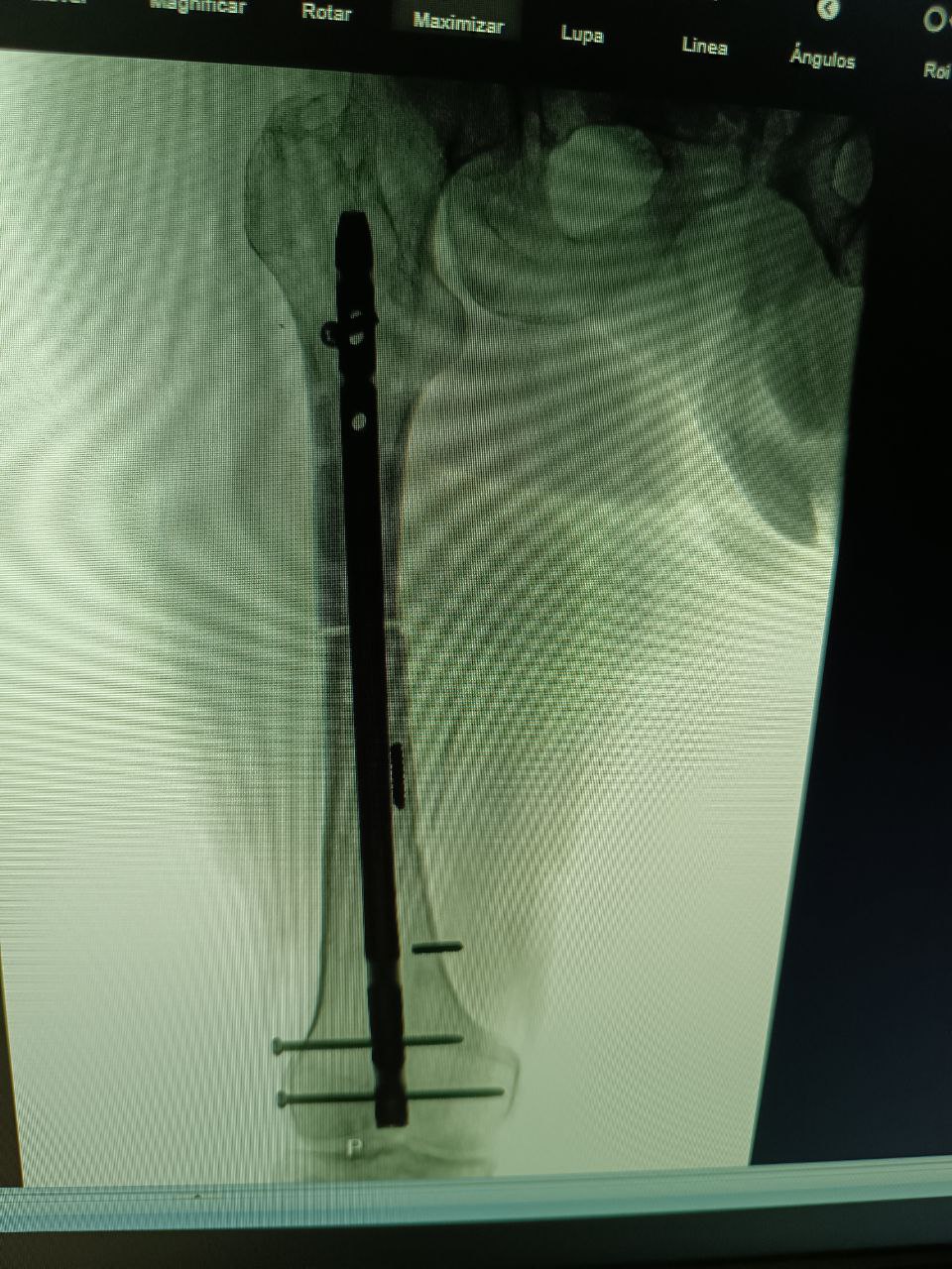 Radiografía de osteosíntesis de pelvis y fémur
