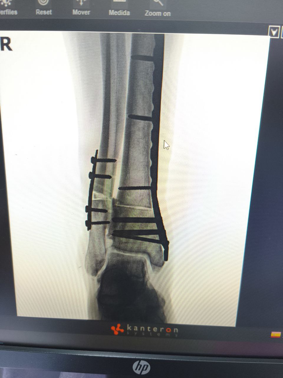 Radiografía de osteosíntesis de tobillo