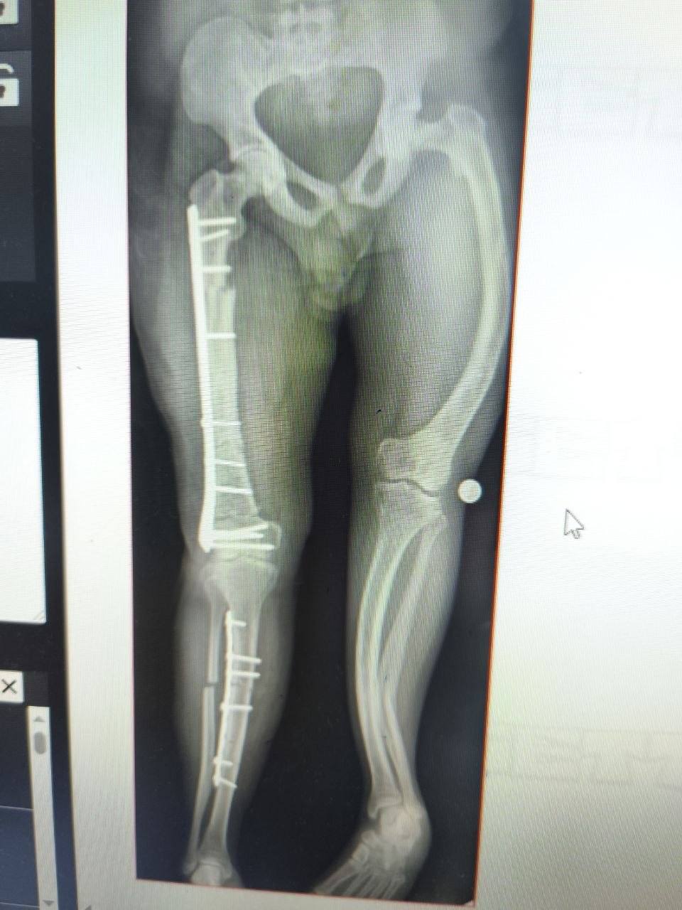 Radiografía de pelvis con placa de fijación